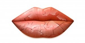 Vitamin B6 Deficiency, Symptoms and Signs in adults dry sore lips